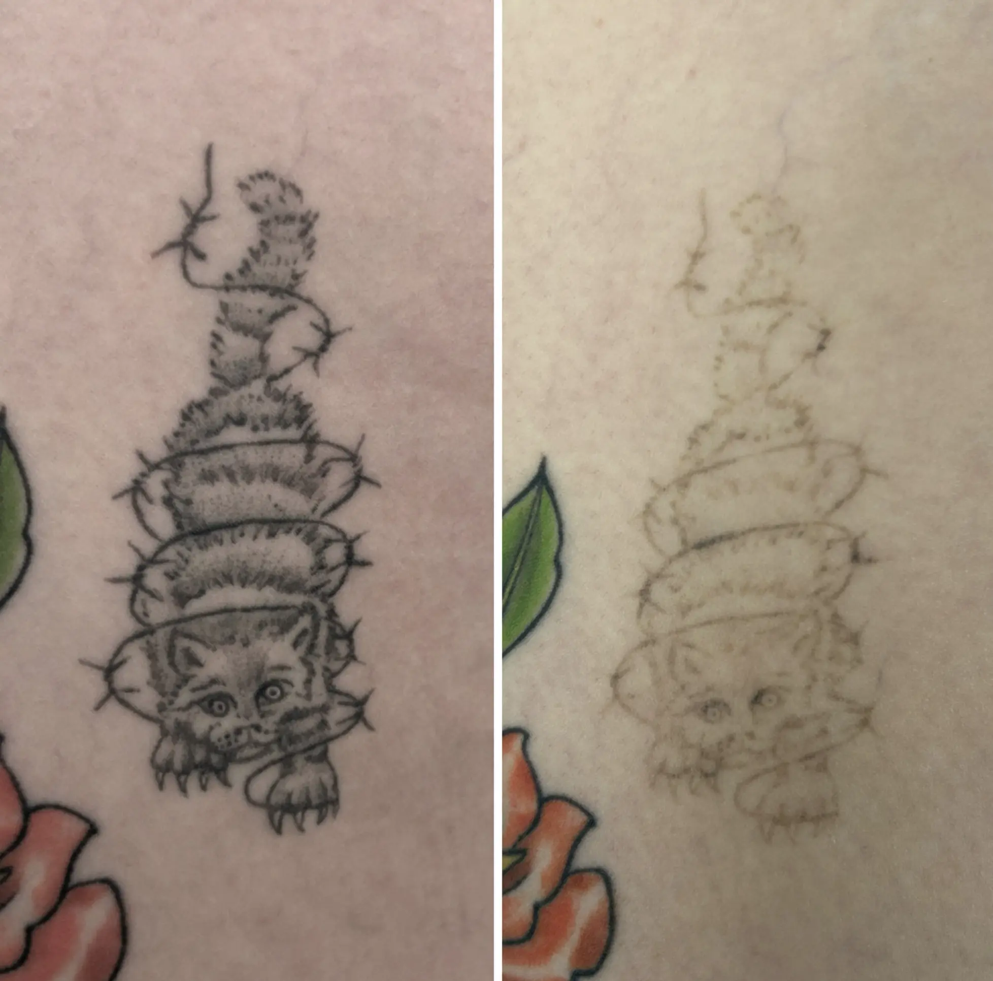 Can You 100% Remove a Tattoo?